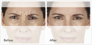 XEOMIN Before & After